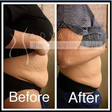 EvolveX: stomach - before and after 4