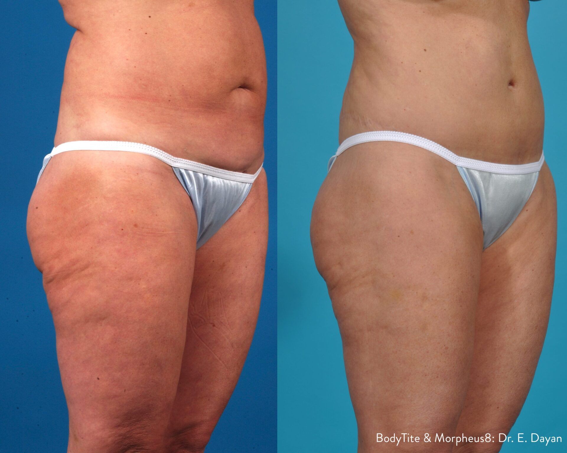Cellulite treatment - before and after 6