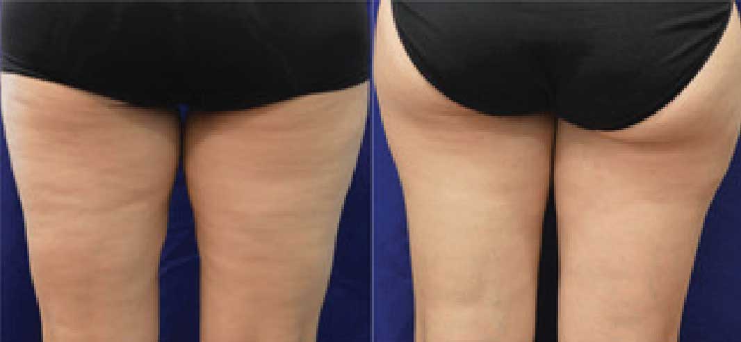 Evolve cellulite treatment: before and after 1