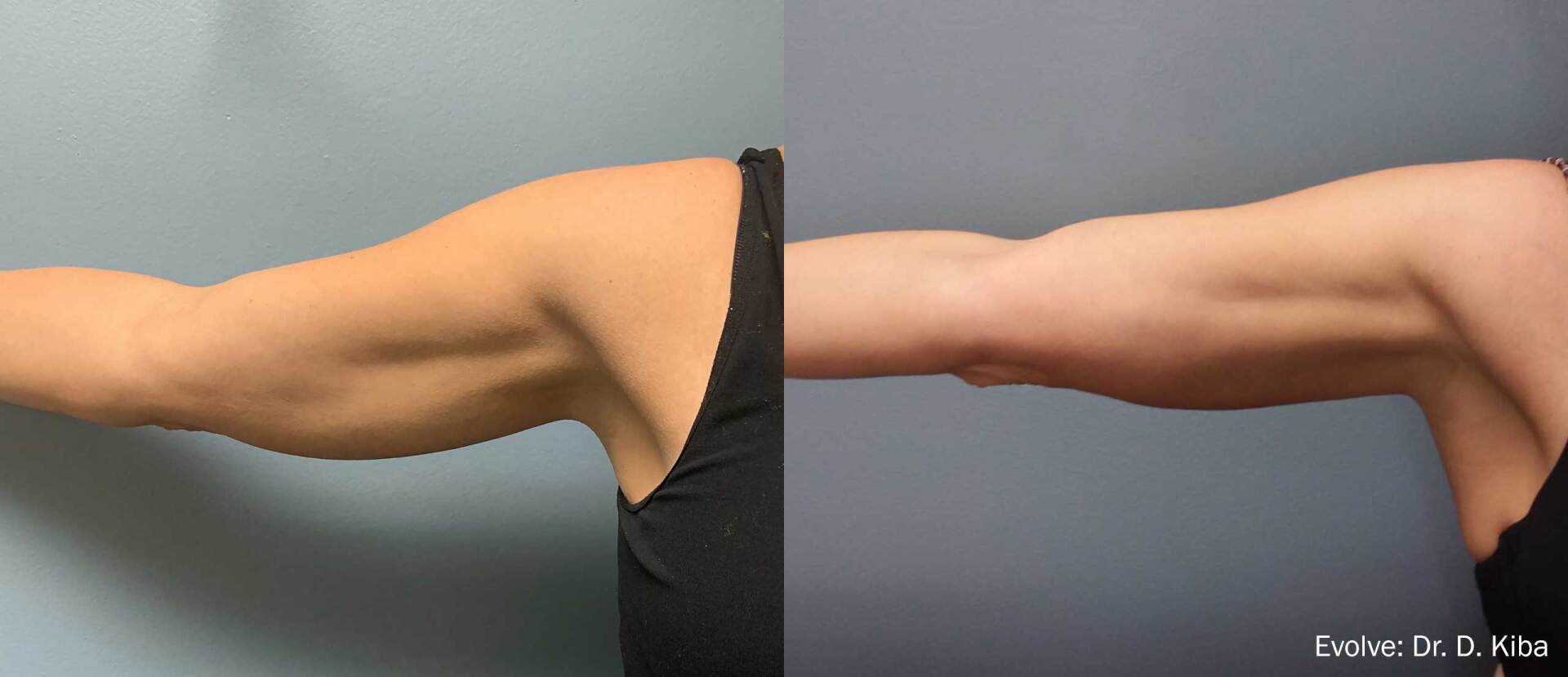 Evolve body sculpting: arms - before and after