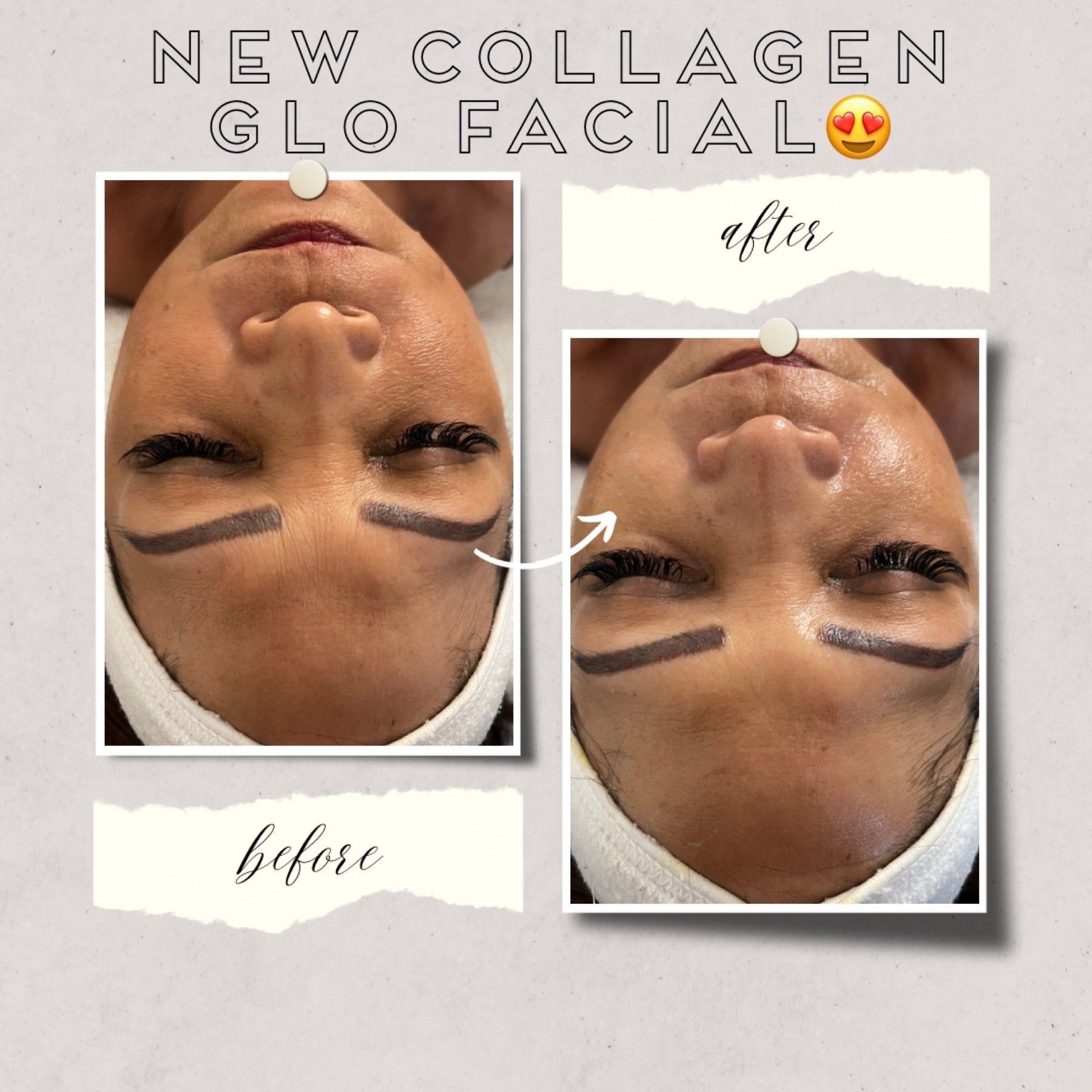 Collage glow facial - before and after
