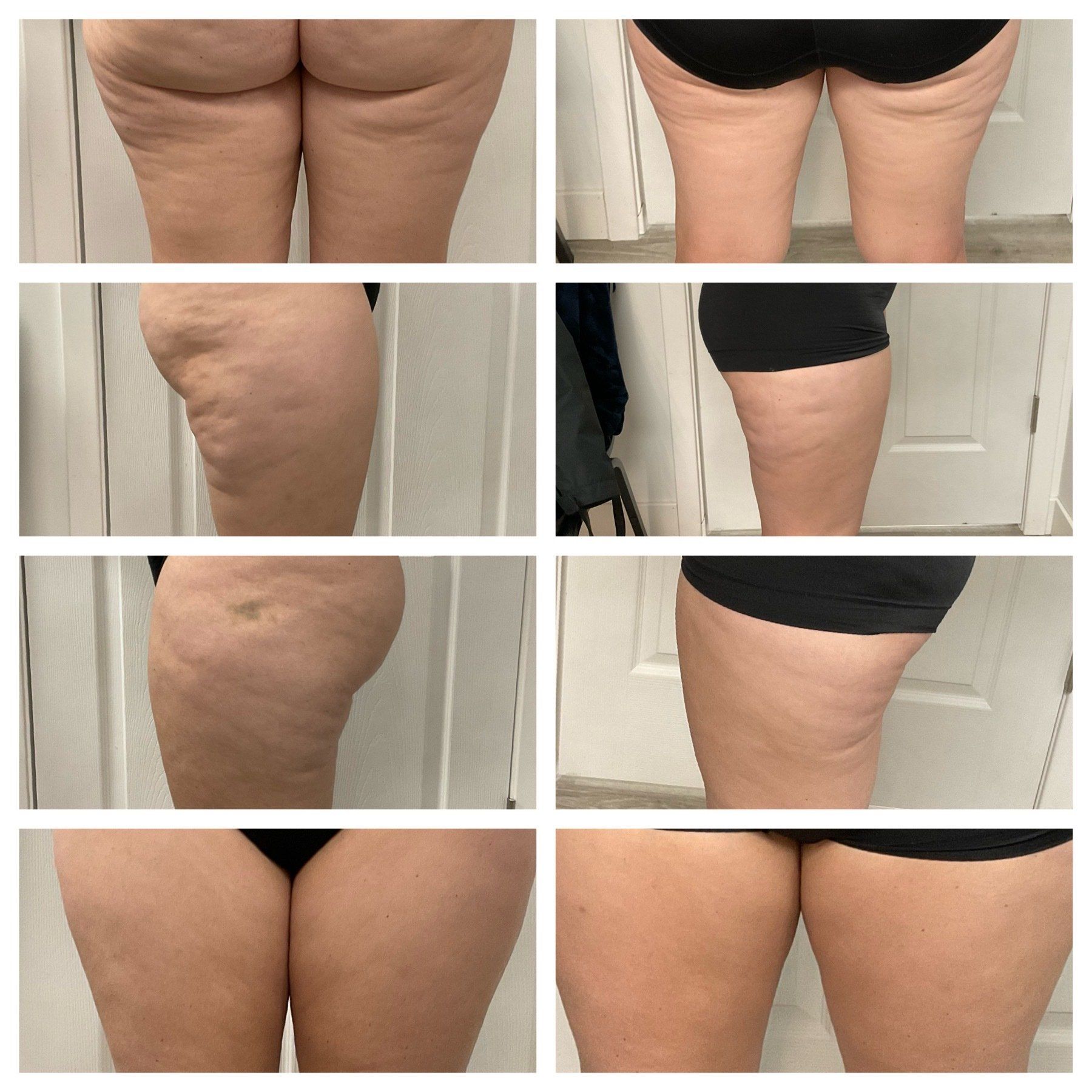Cellulite treatment: before and after 3