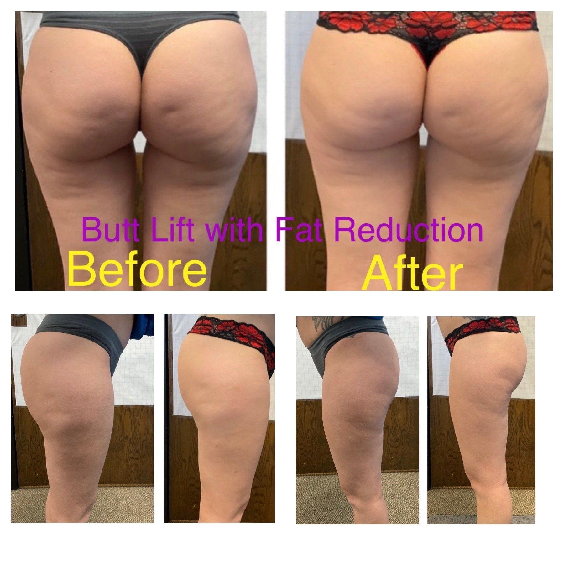 Butt lift - before and after