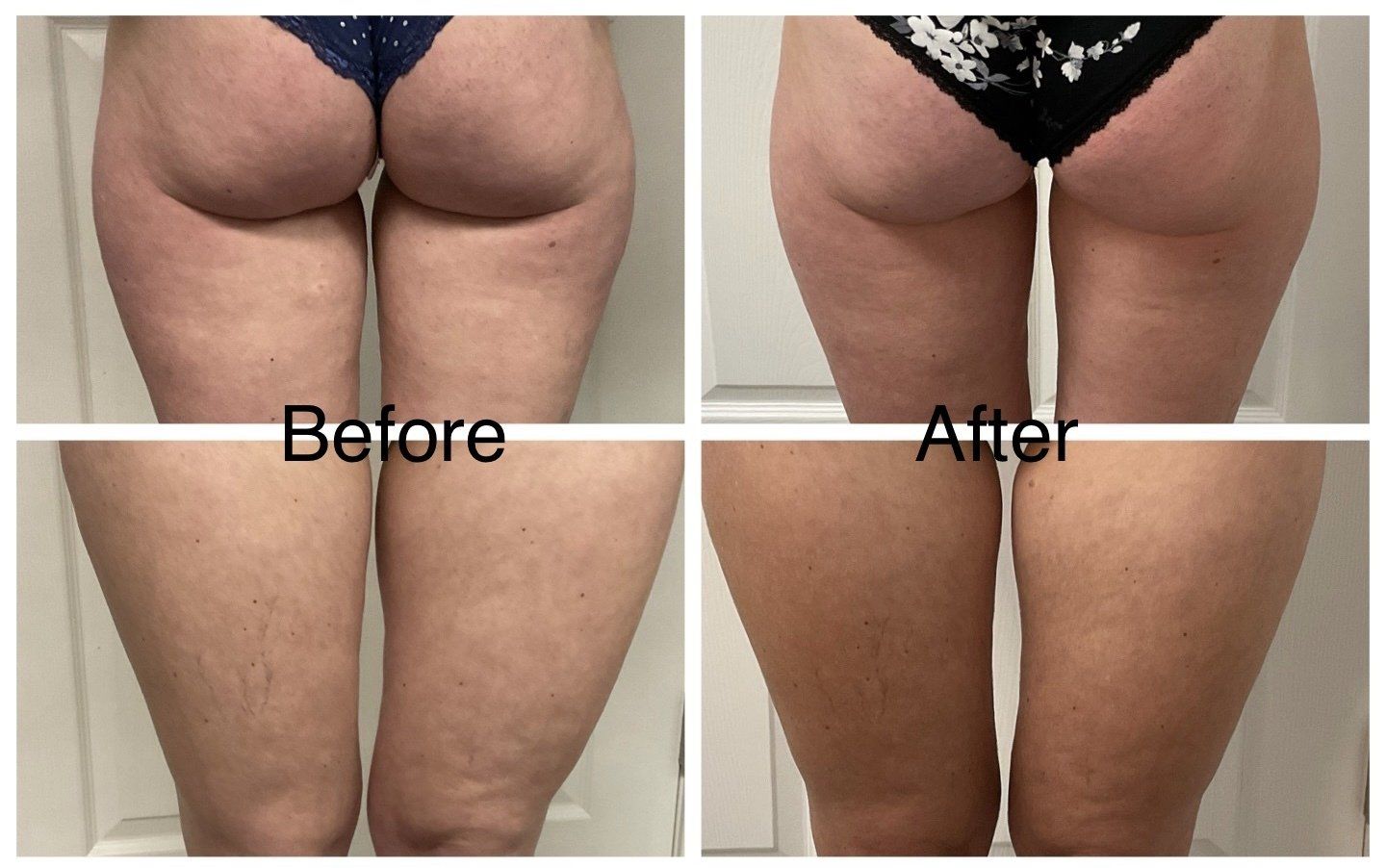 Cellulite treatment: before and after 2