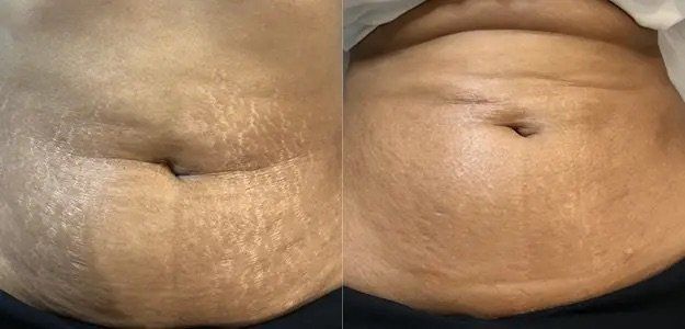 Microneedling - before and after 3
