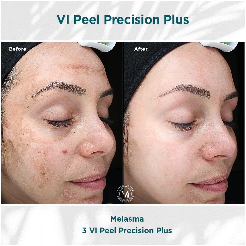 VI peel - before and after