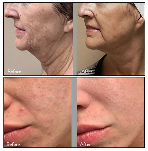 Morpheus8 - before and after 8