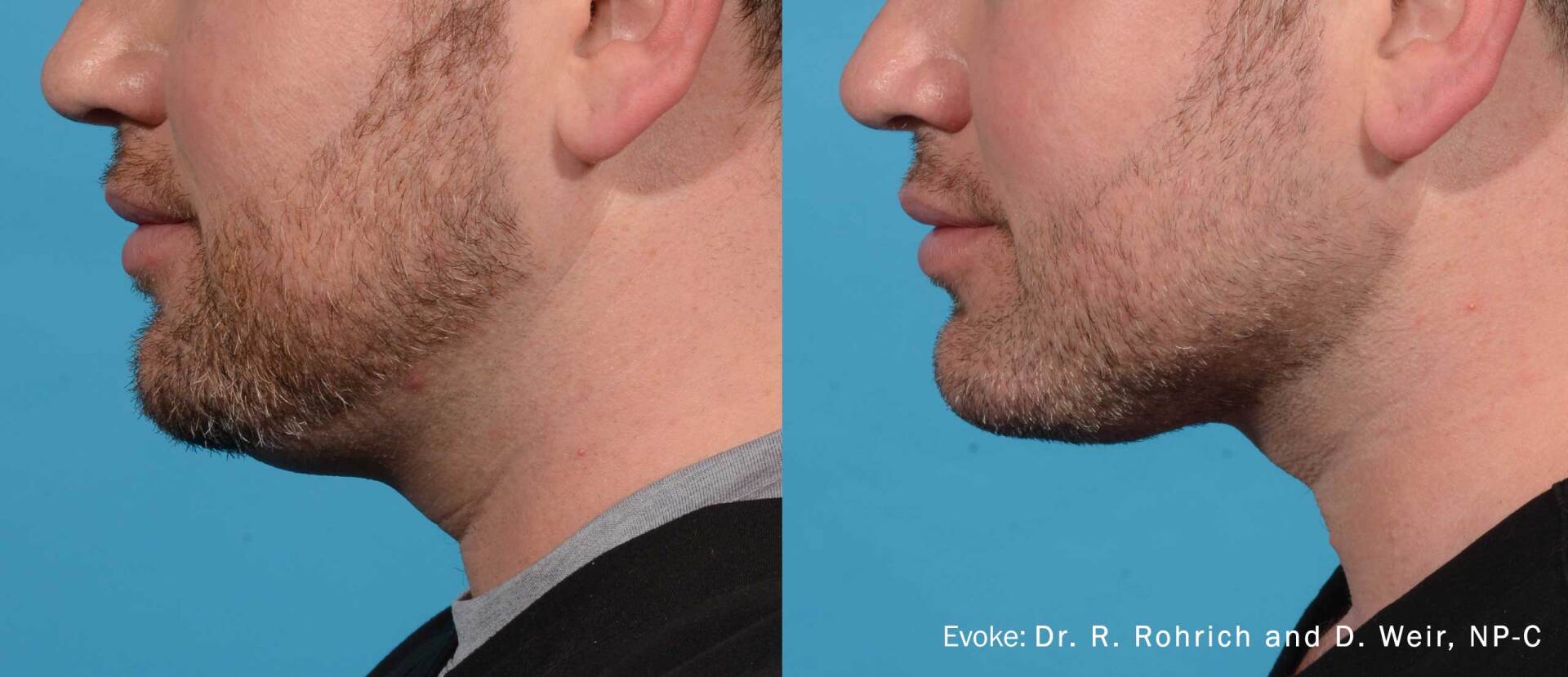 Double chin removal - before and after 12