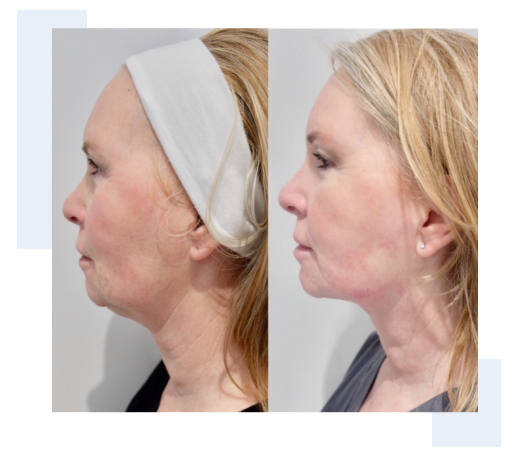 Loose skin treatment - before and after 8