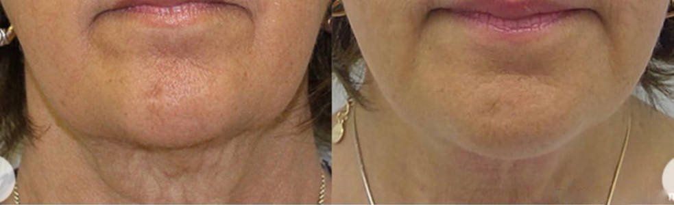 Loose skin treatment - before and after 10