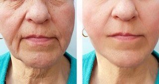Loose skin treatment - before and after 9