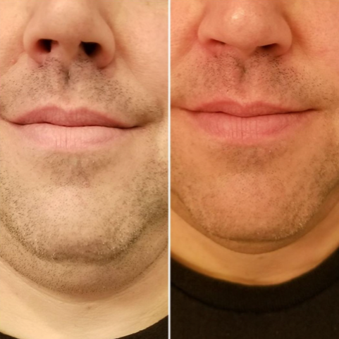 Double chin removal - before and after 11