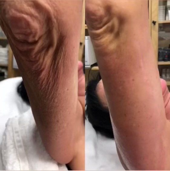 Morpheus8 - before and after 9