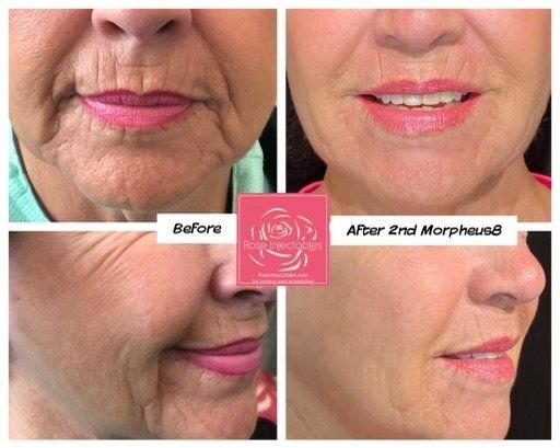 Morpheus8 - before and after 4