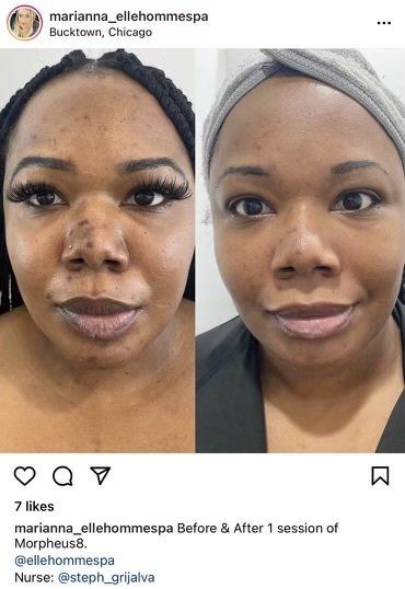 Morpheus8 - before and after 3