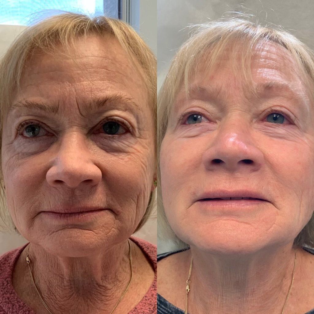 Morpheus8 - before and after 2