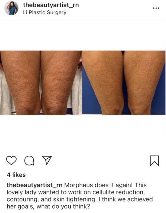 Morpheus8 - before and after 1