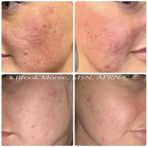 Microneedling - before and after 7
