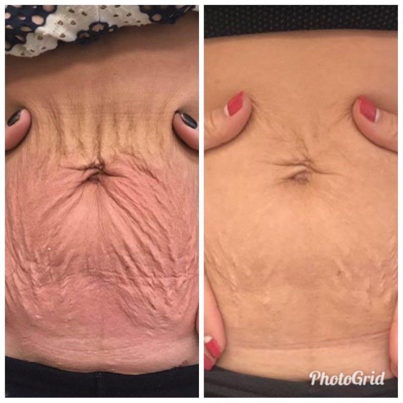 Microneedling - before and after 6