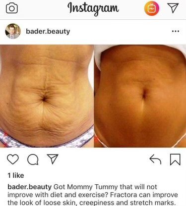 Microneedling - before and after 5