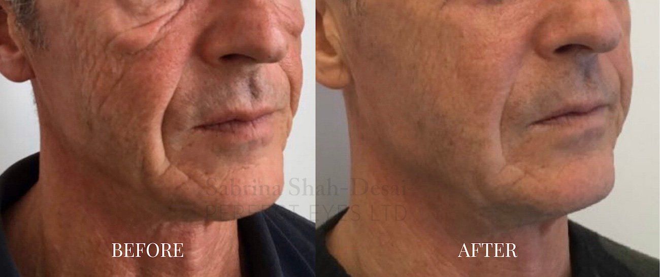 Wrinkle reduction - before and after 3