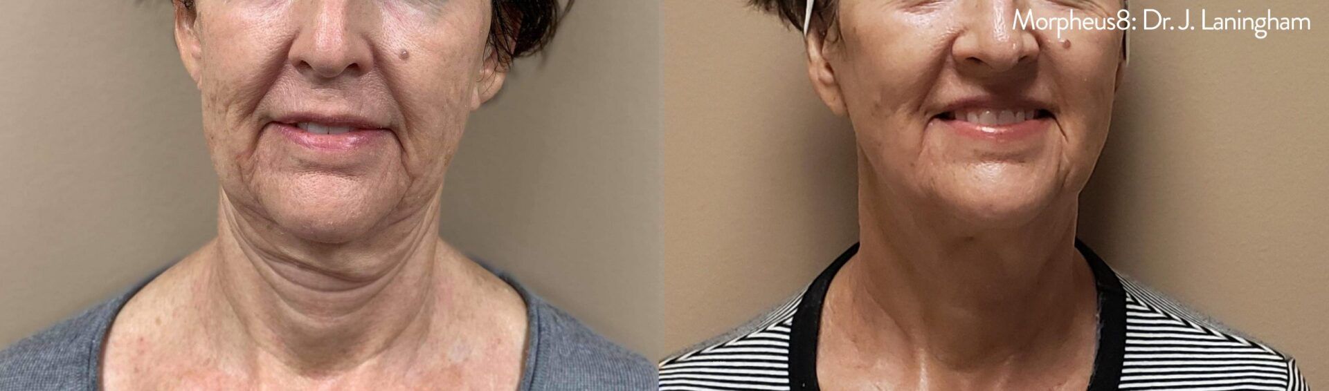 Loose skin treatment - before and after 12