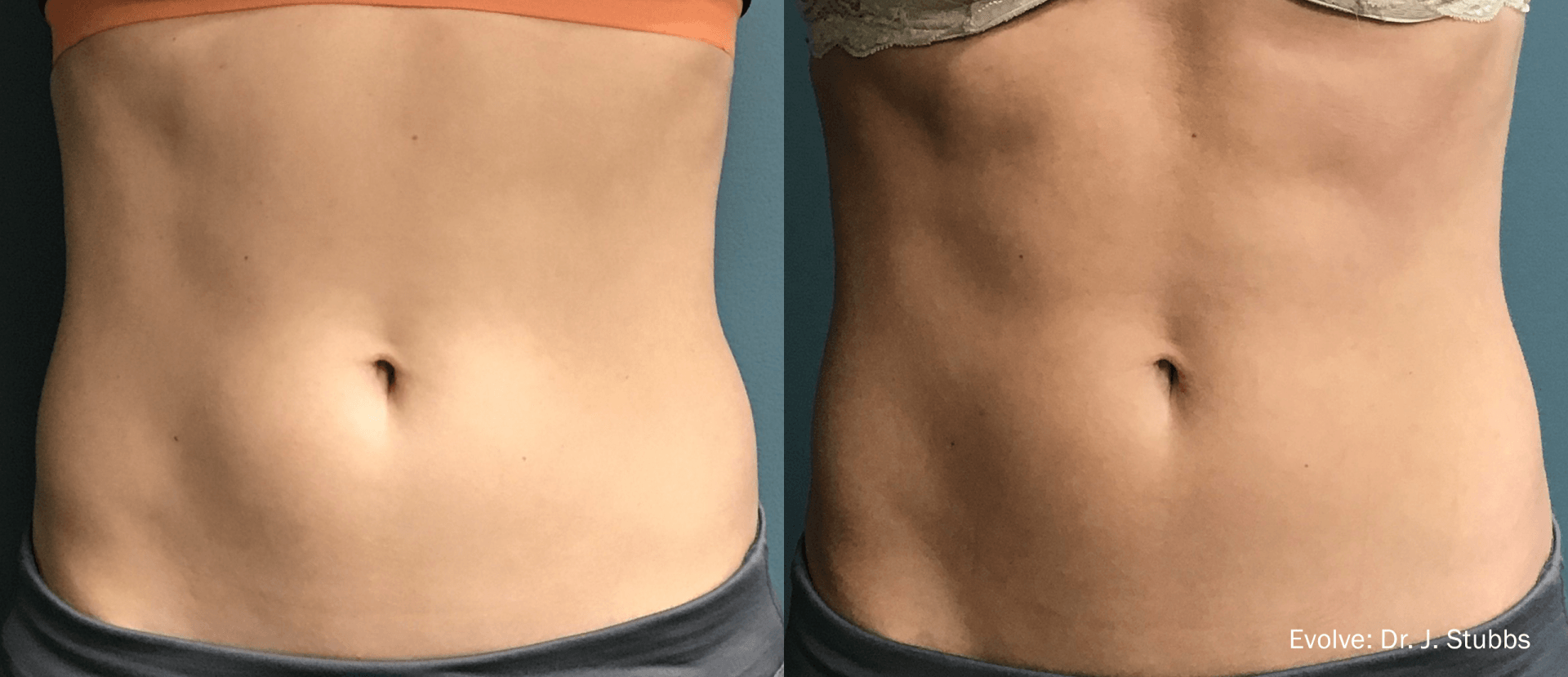 Evolve: before and after 6