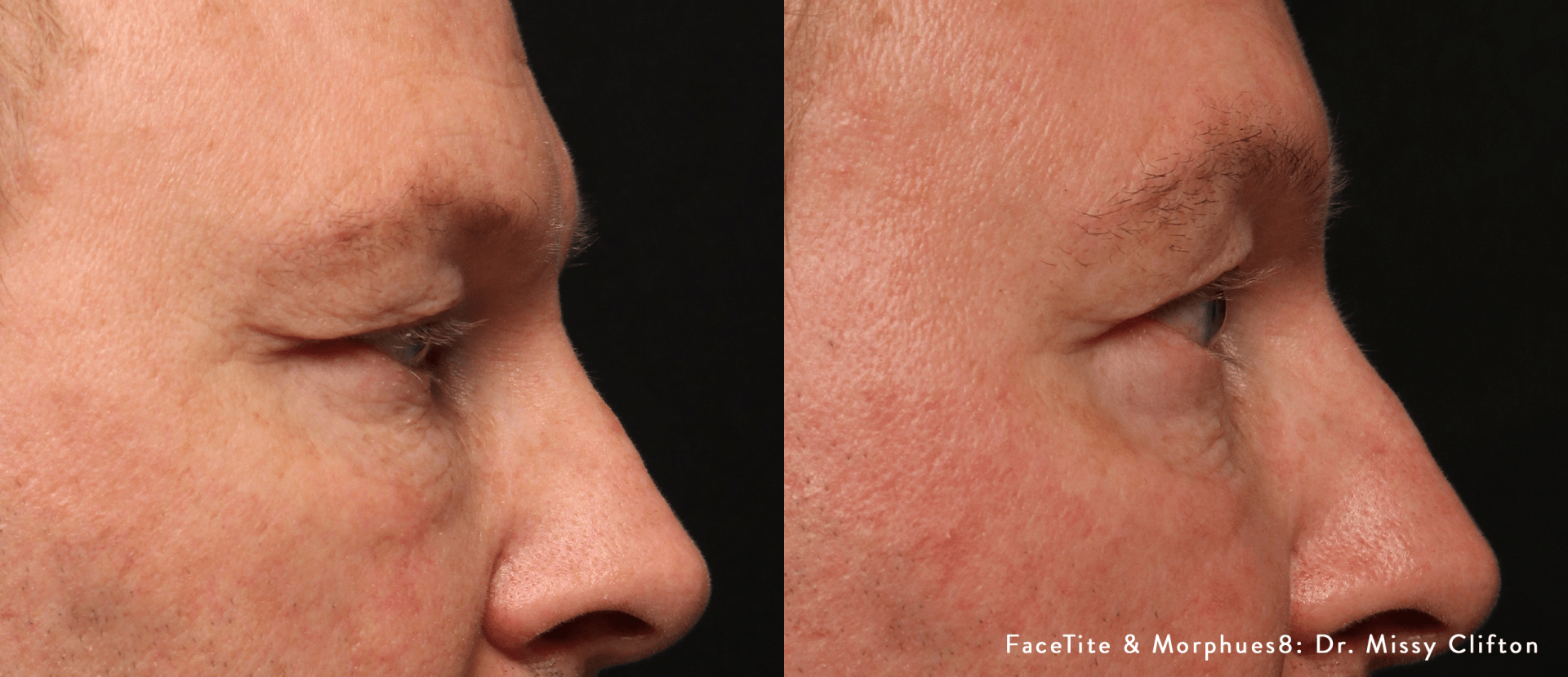 Morpheus8 crows feet: before and after 1