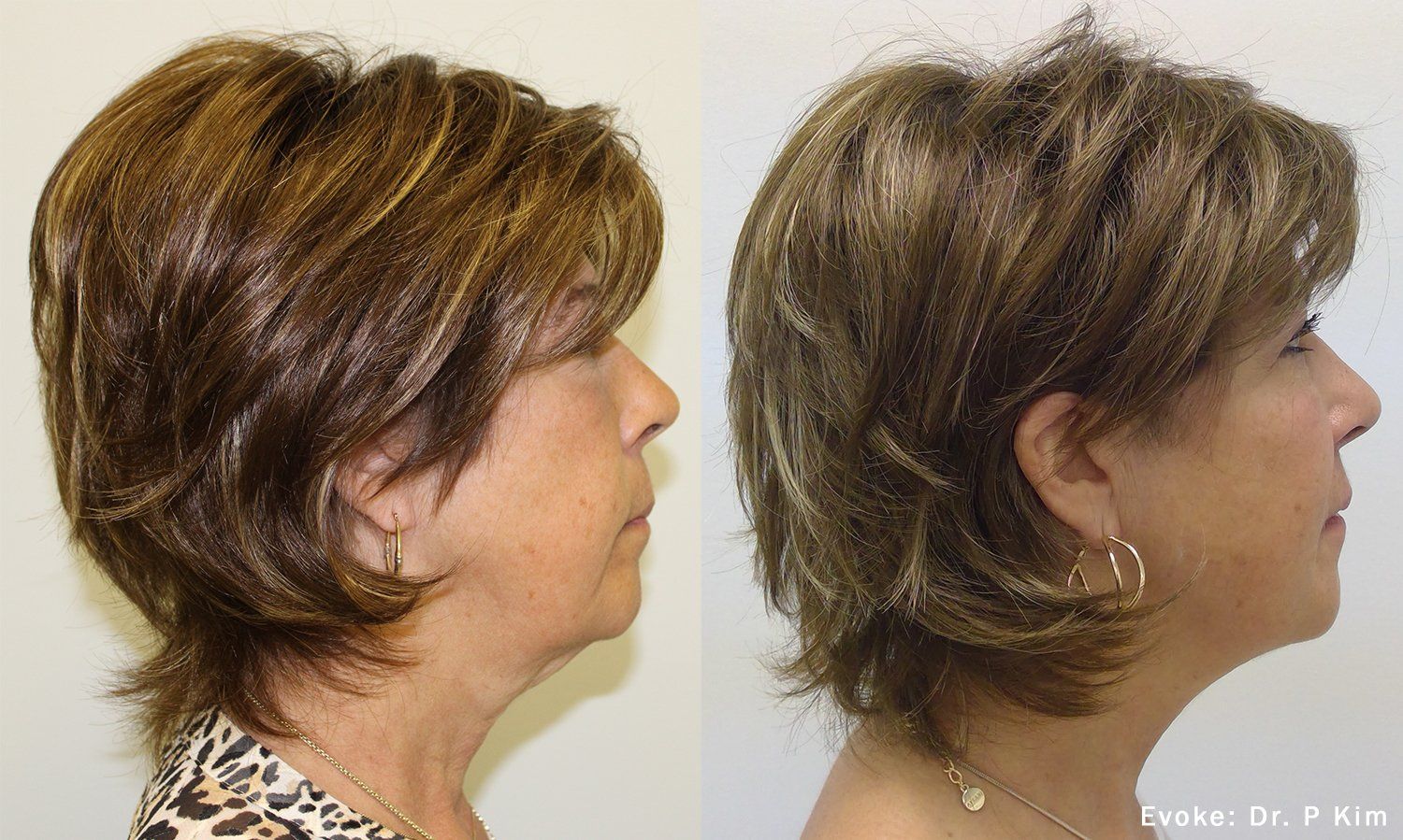 Evoke: before and after chin 2