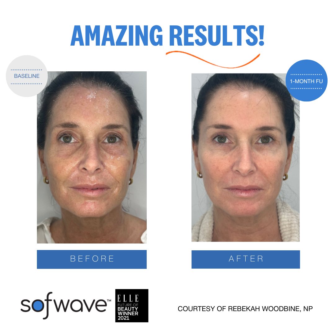 Sofwave before and after results