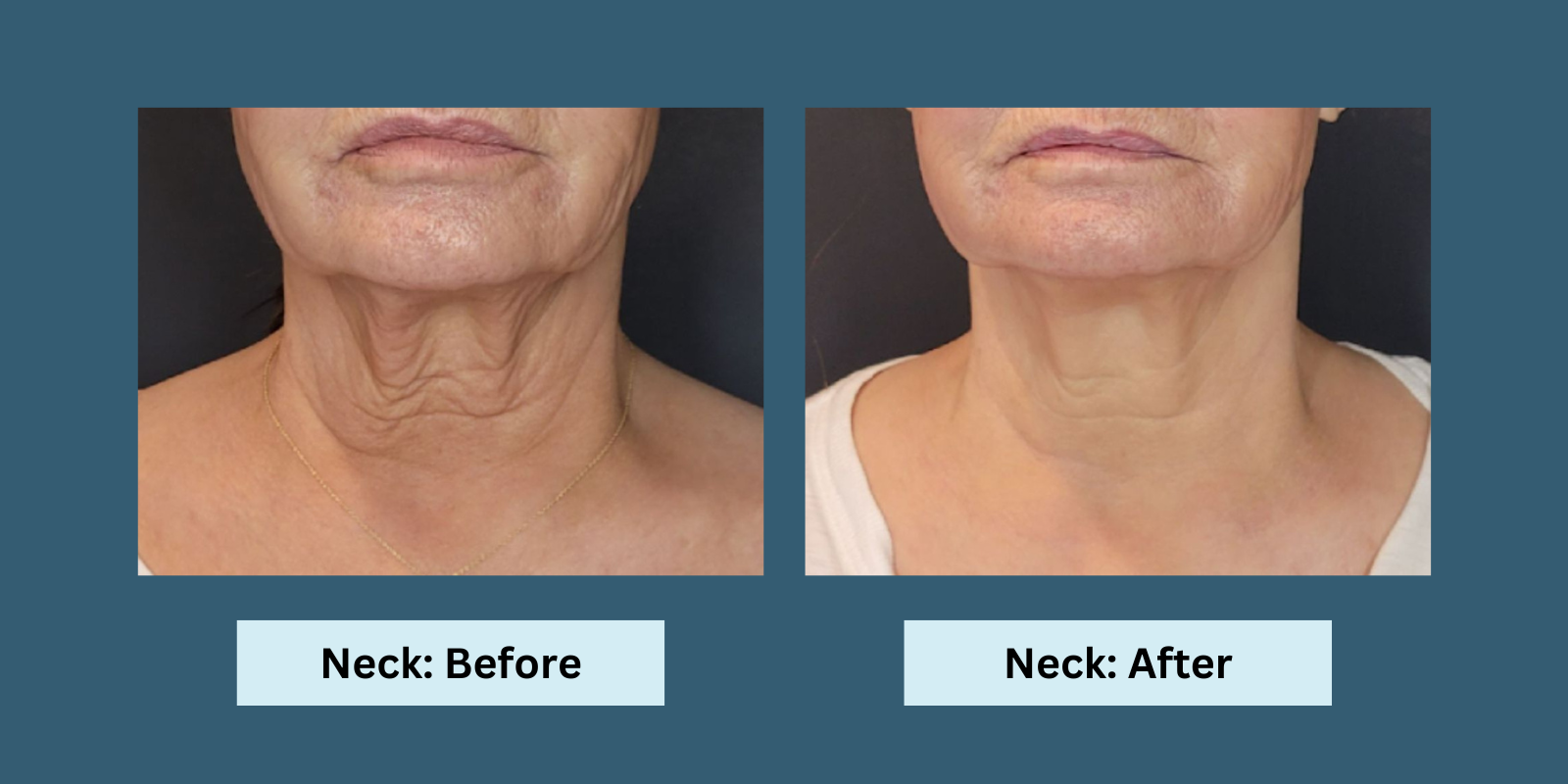 Sofwave treatment for neck: Before and After pictures