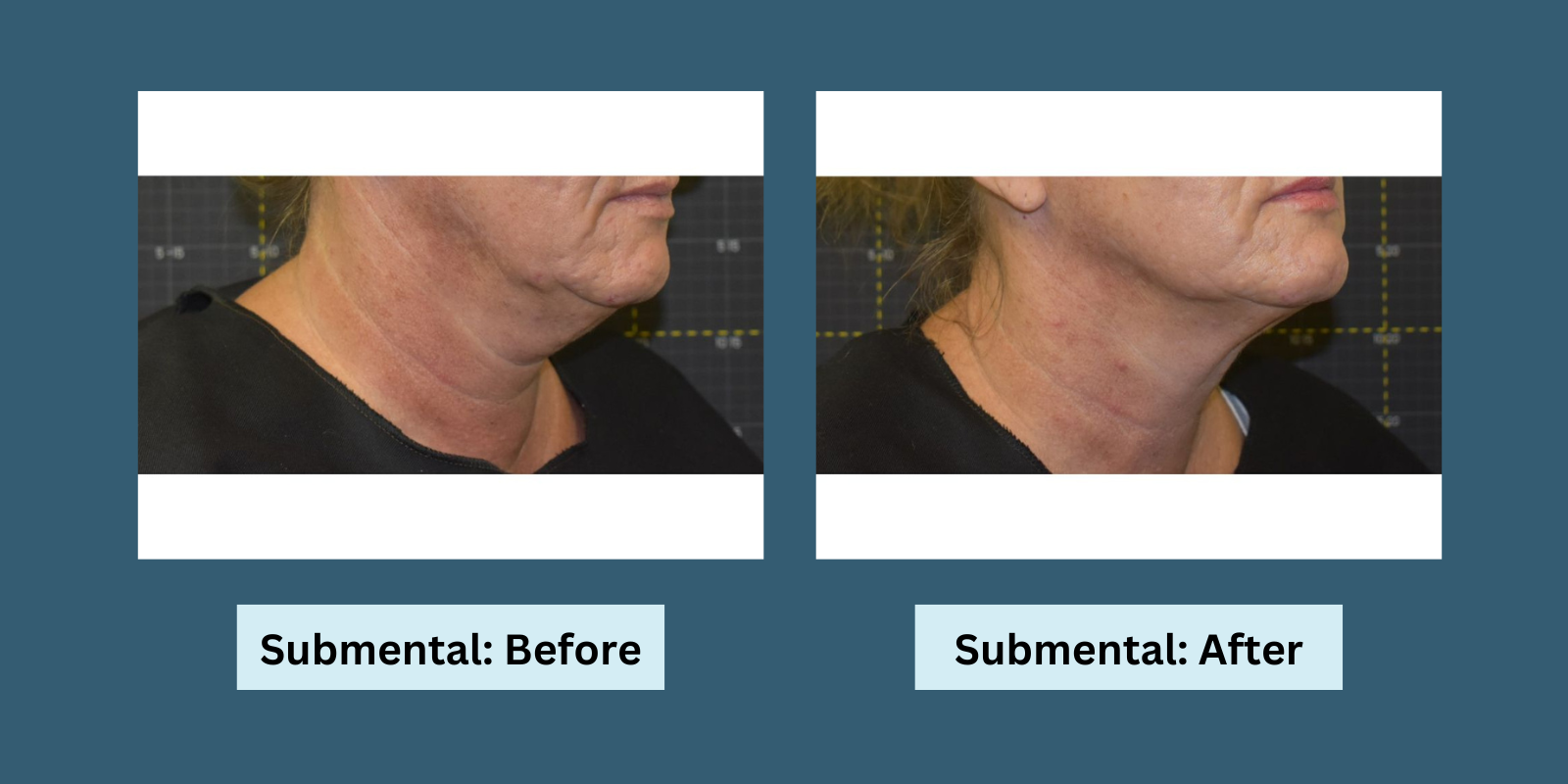 Sofwave treatment for double chin: Before and After pictures