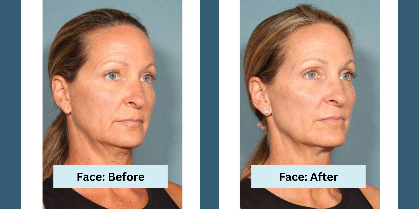 Sofwave treatment for face: Before and After pictures