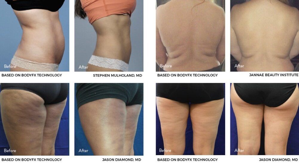 Cellulite treatment with Evolve