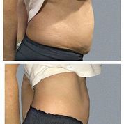 fat freezing results