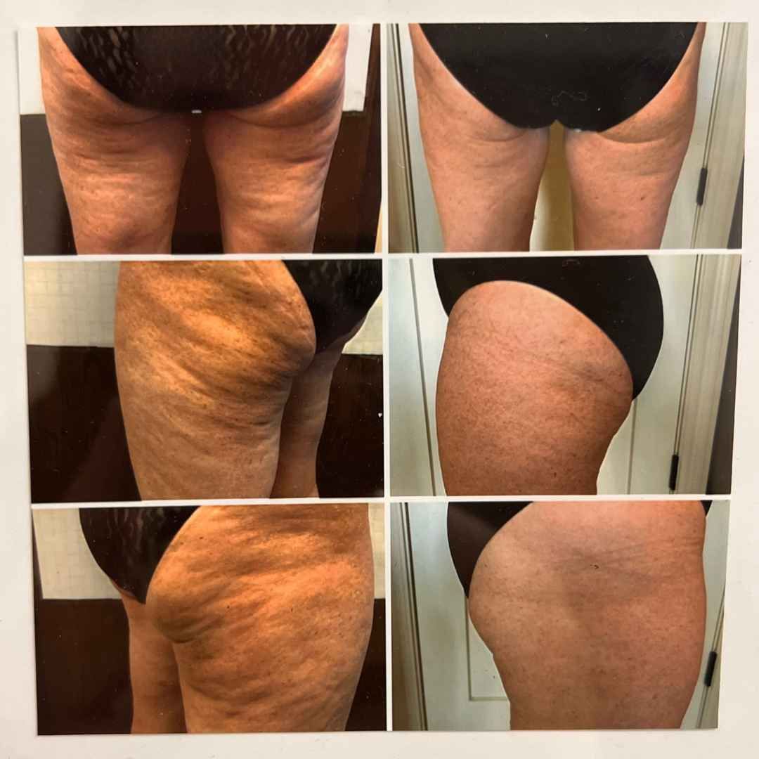 A woman 's legs are shown before and after a treatment