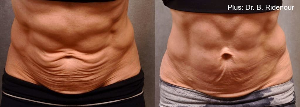 EvolveX: stomach - before and after 5