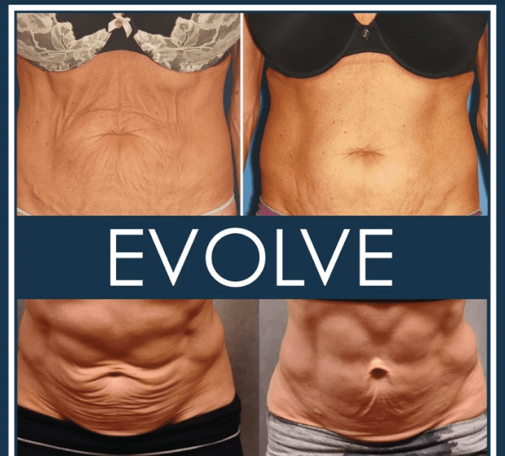 Evolve: stomach - before and after 5