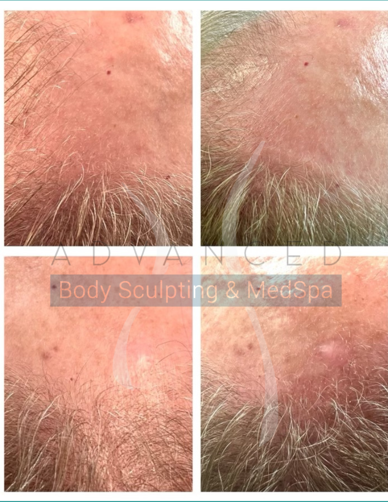 before and after microneedling for hair growth