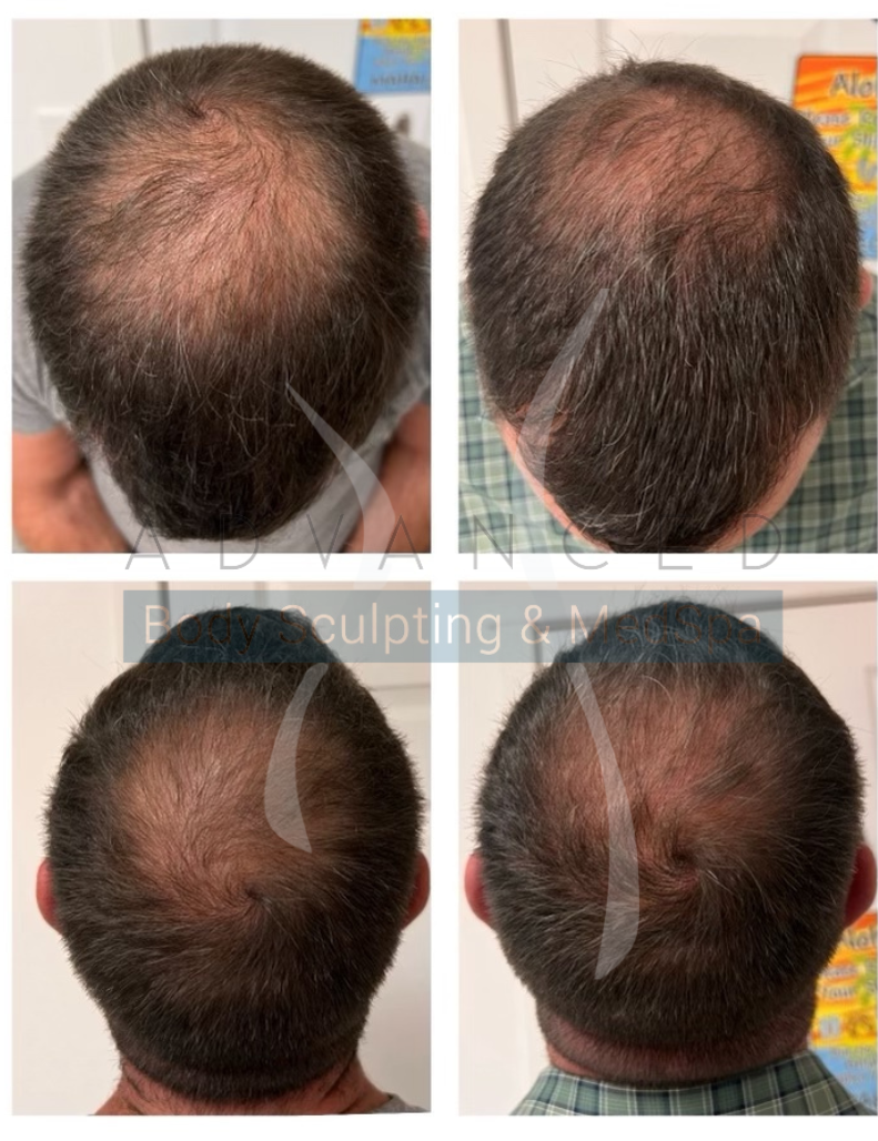 Hair restoration2, before and after - 30 days