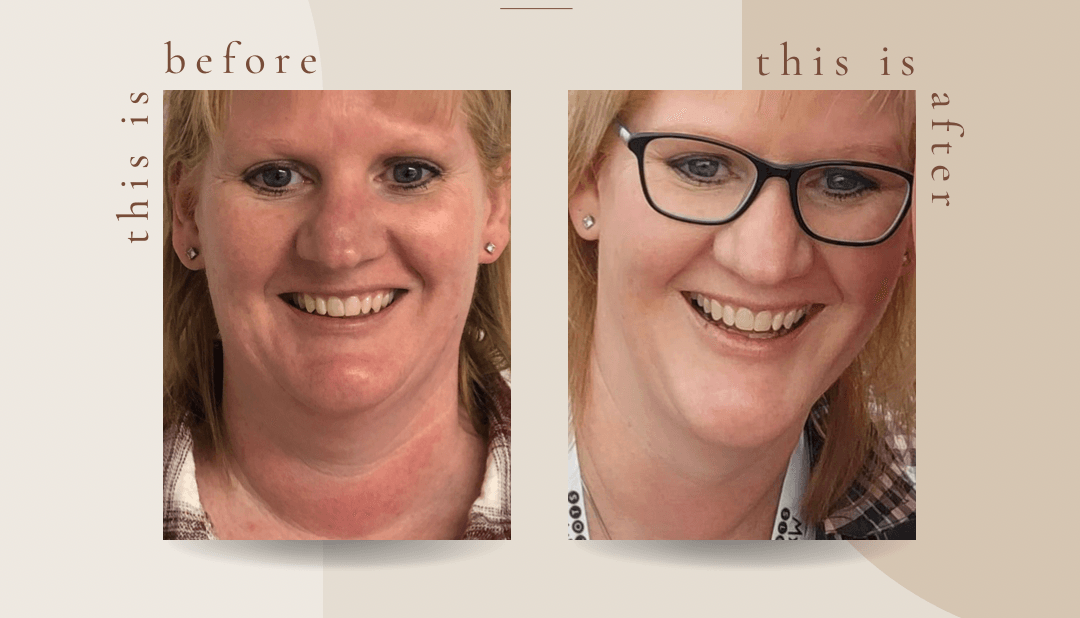 before and after of neck and jawline