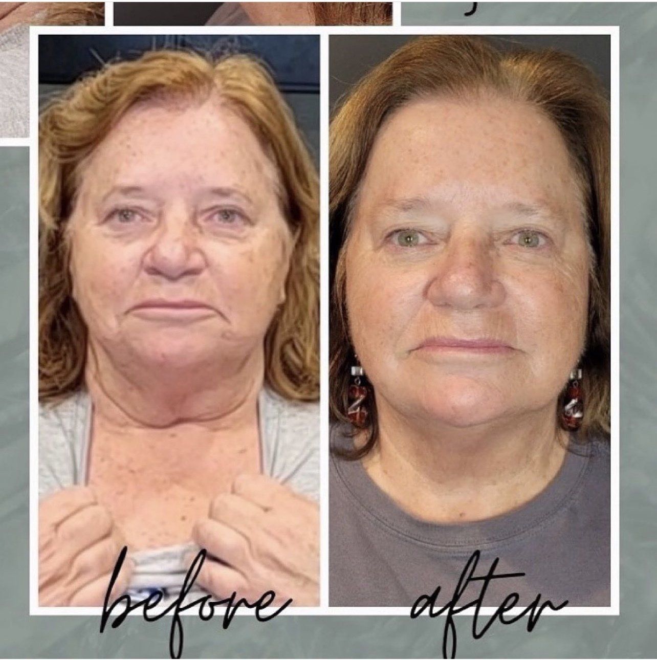 face and neck lift - before and after 2