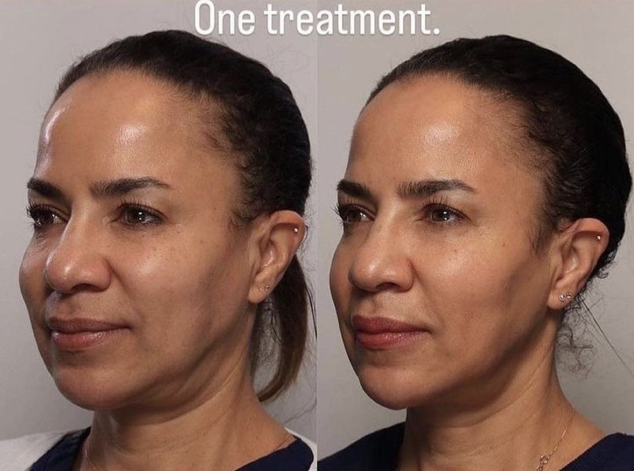 face and neck lift - before and after 1