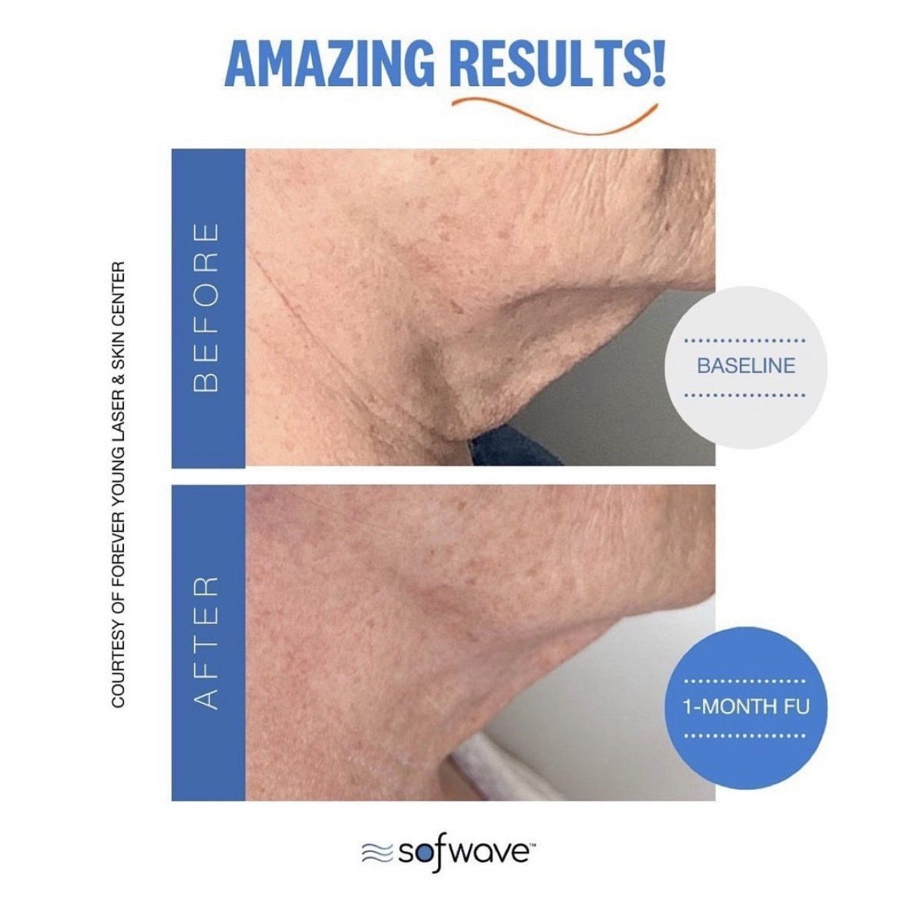 Sofwave face lift - before and after 1