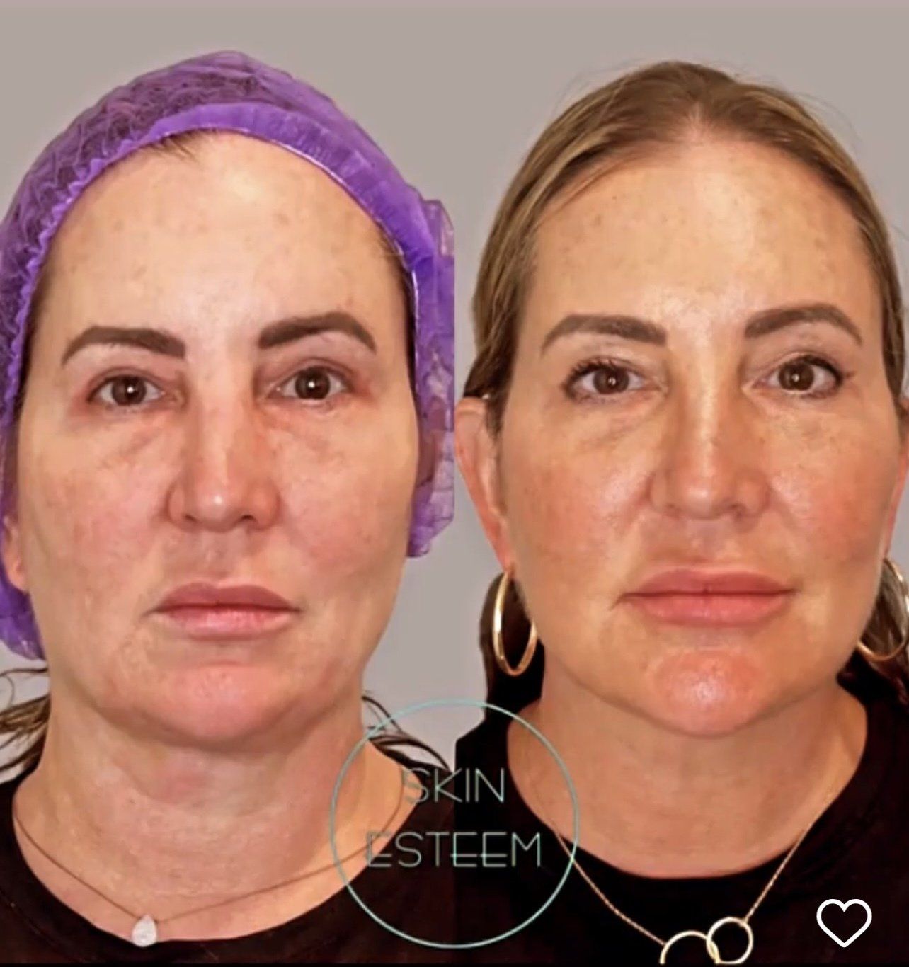 face and neck lift - before and after 3