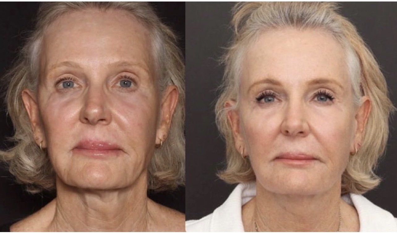 Sofwave face lift - before and after 8