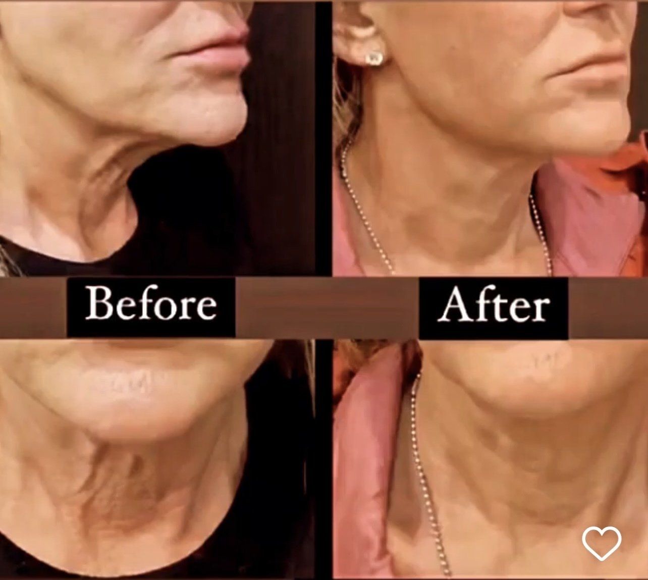 Sofwave face lift - before and after 9