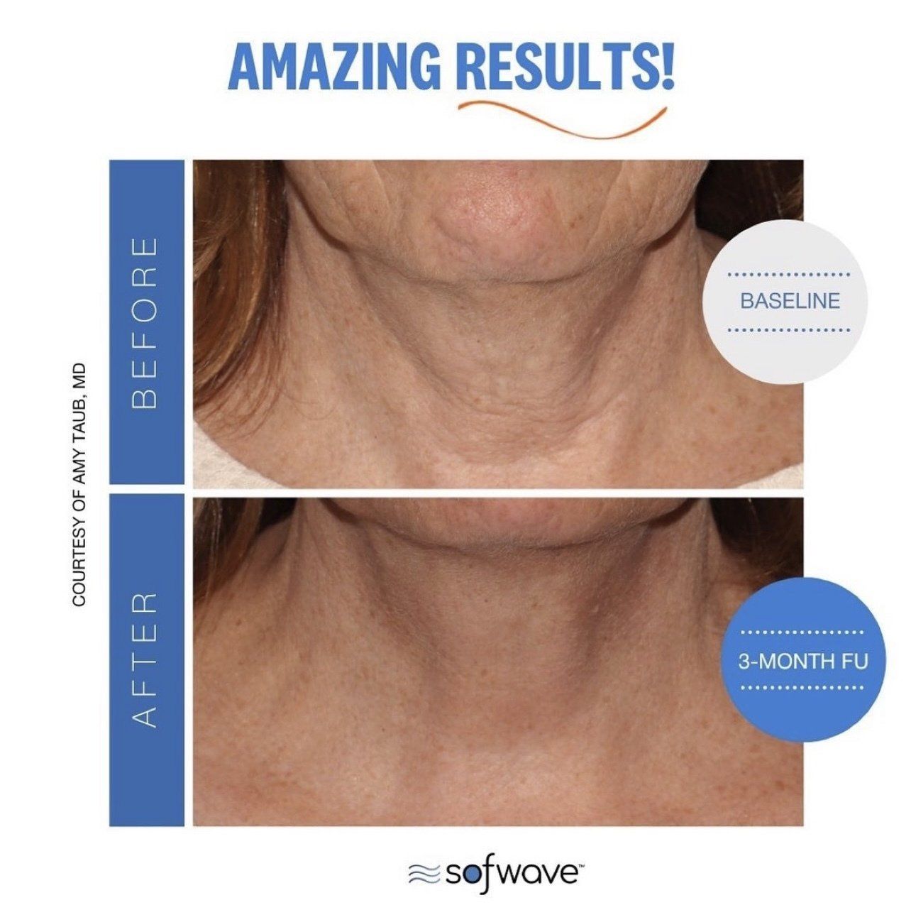 Sofwave face lift - before and after 7