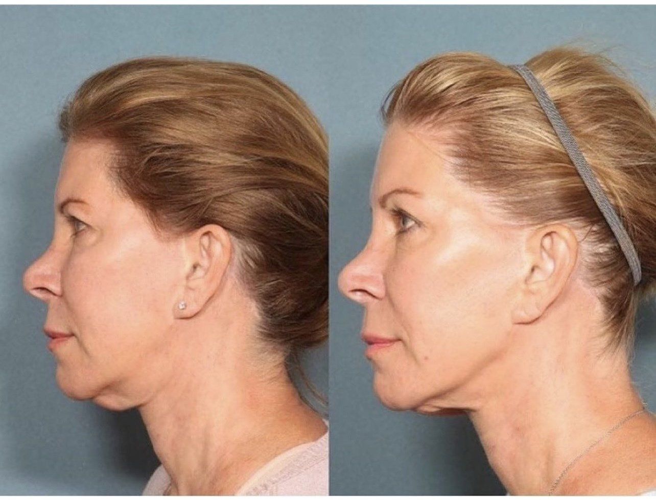 Sofwave face lift - before and after 5
