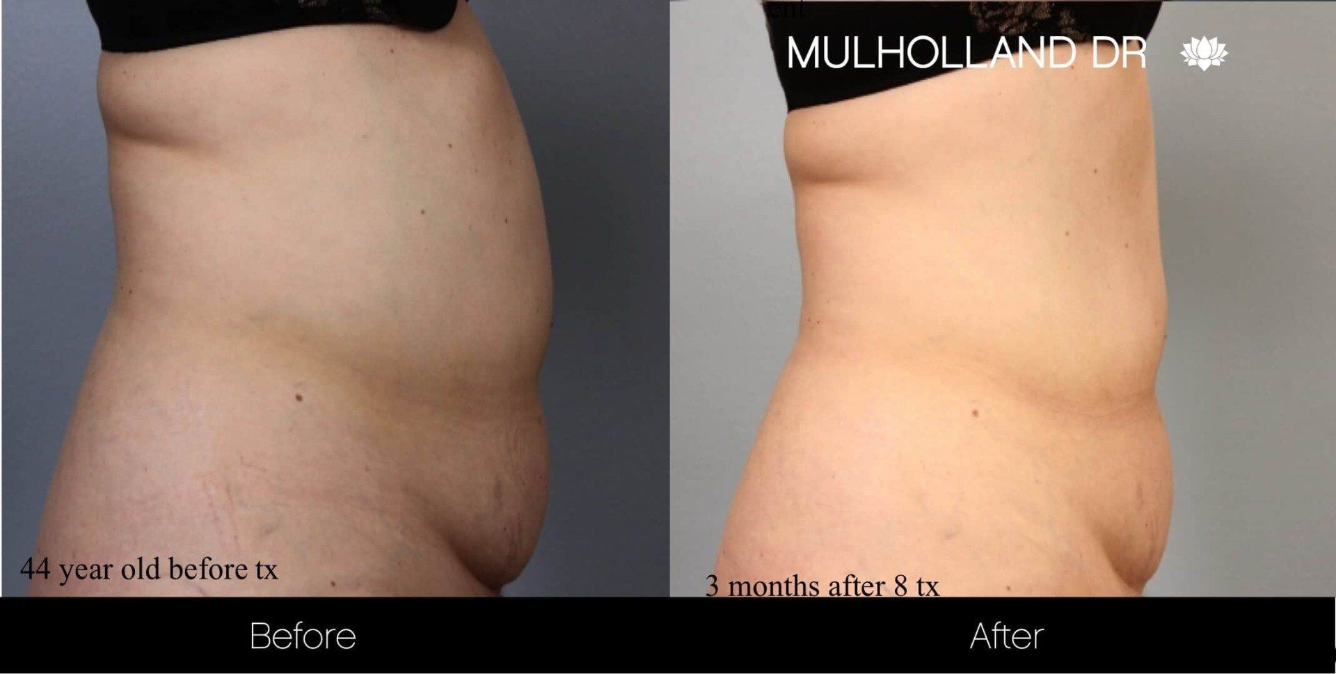 Evolve: stomach - before and after 4
